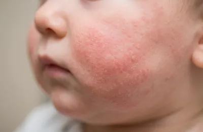 乳児湿疹・おむつかぶれ