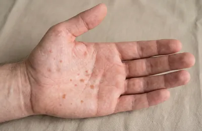 梅毒・性感染症