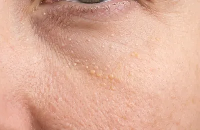 稗粒腫・汗管腫