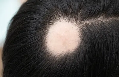 円形脱毛症