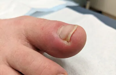 巻き爪・陥入爪